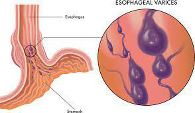 Types of esophageal varices