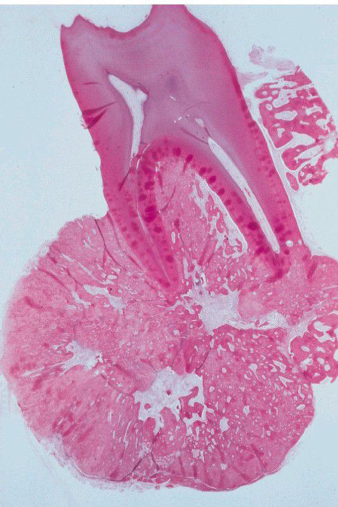 Cementoblastoma