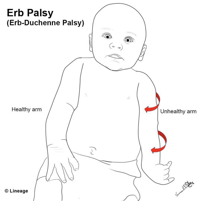 Erb's palsy