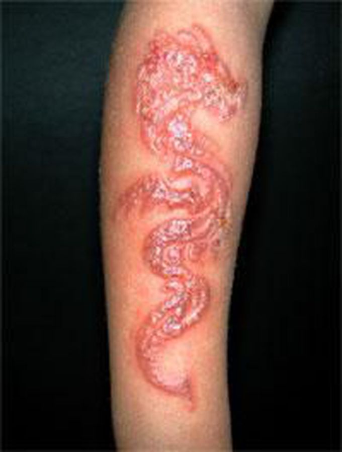 type 4 allergic reaction