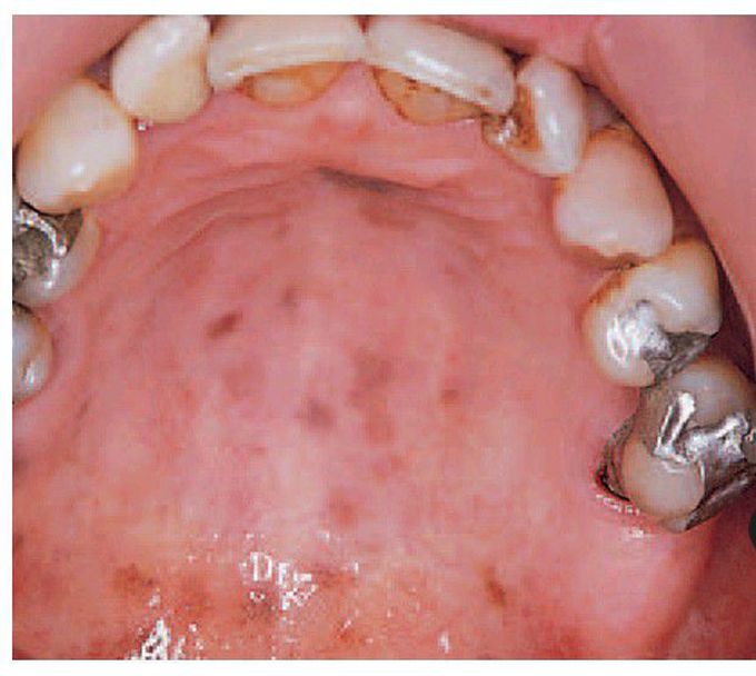 Peutz–Jehgers syndrome.