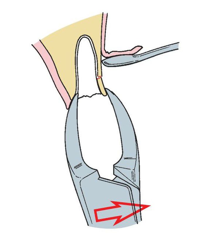 Fractured root extraction