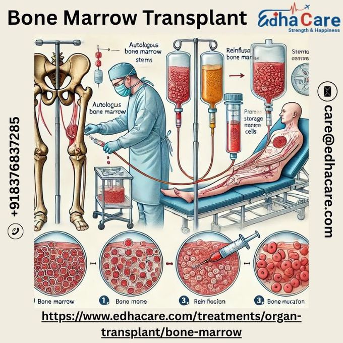 Bone Marrow Transplant Procedure, Uses and Benefits