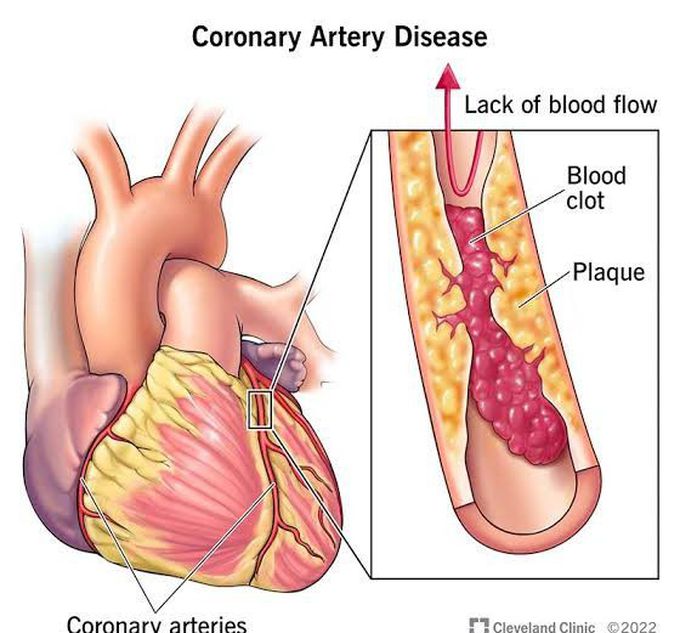 Can Lung Disease Cause Heart Problems