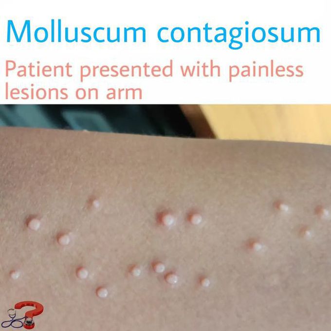 Molluscum Contagiosum