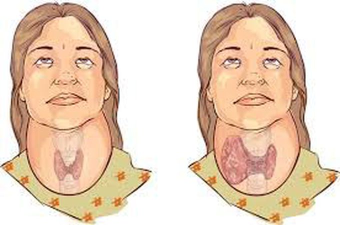 What is goiter
