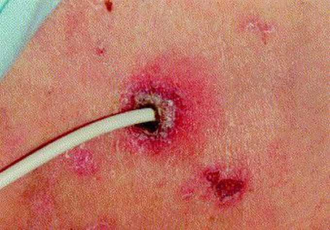 Catheter-related Sepsis