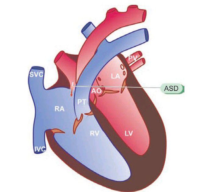 Atrial septal defect