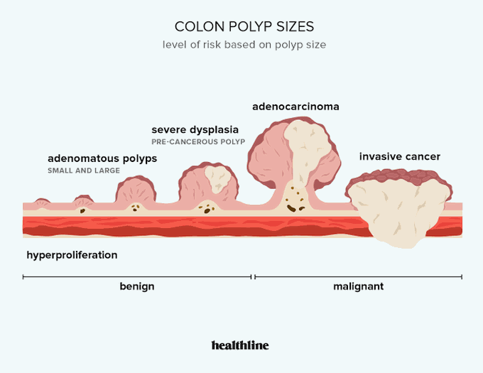 Colon Polyp