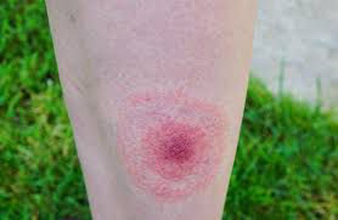 Treatment of lyme disease