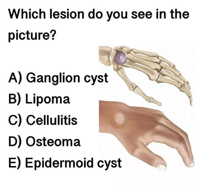 Identify the lesion