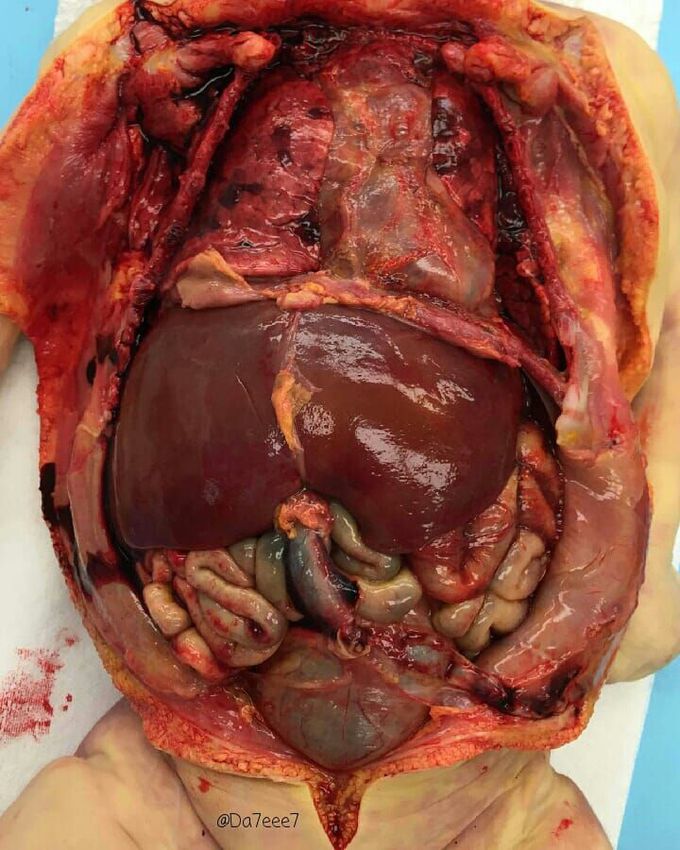 Neonate Autopsy