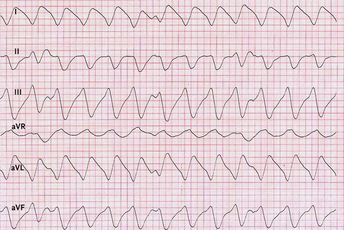 ECG_Study