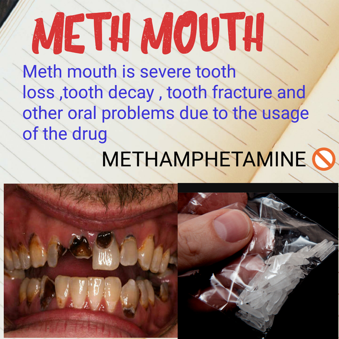 Meth mouth