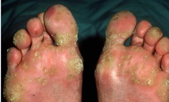 30 years old male patient developed hyperkeratosis in palms and soles. This patient has been asymptomatic previously. No history of diabetes or hypertension. Occasional gastritis episodes used to bother him since last 1 month. What should you suspect in this patient?