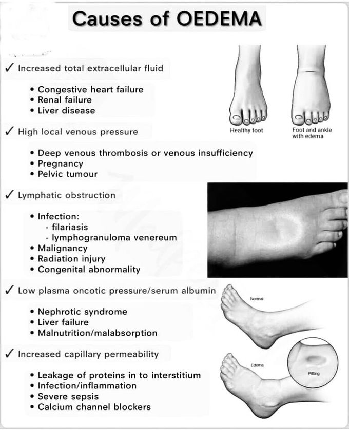 Cause of Oedema