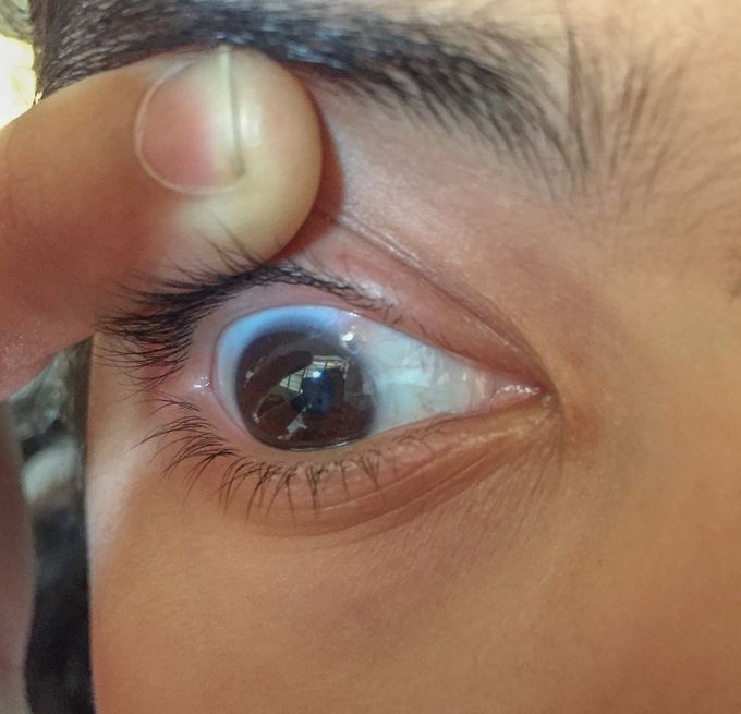 PTERIGIUM