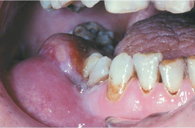 HIV-associated Lymphoma.