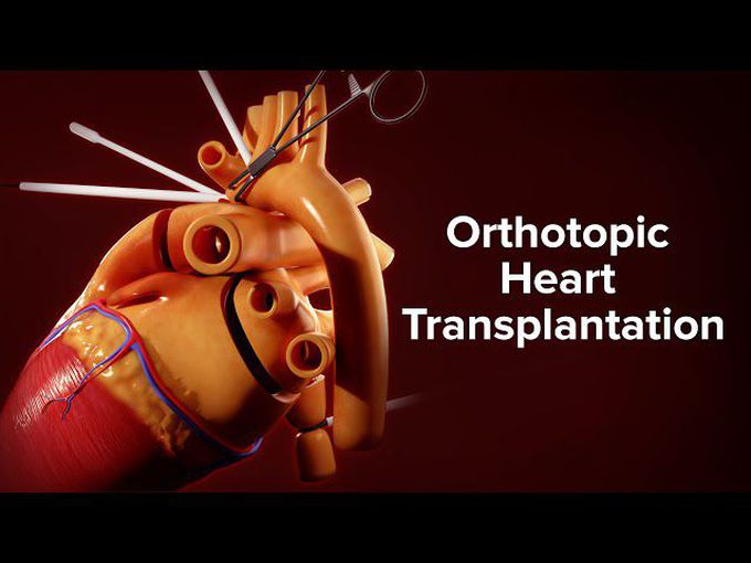 Orthotopic Heart Transplantation-
Procedure