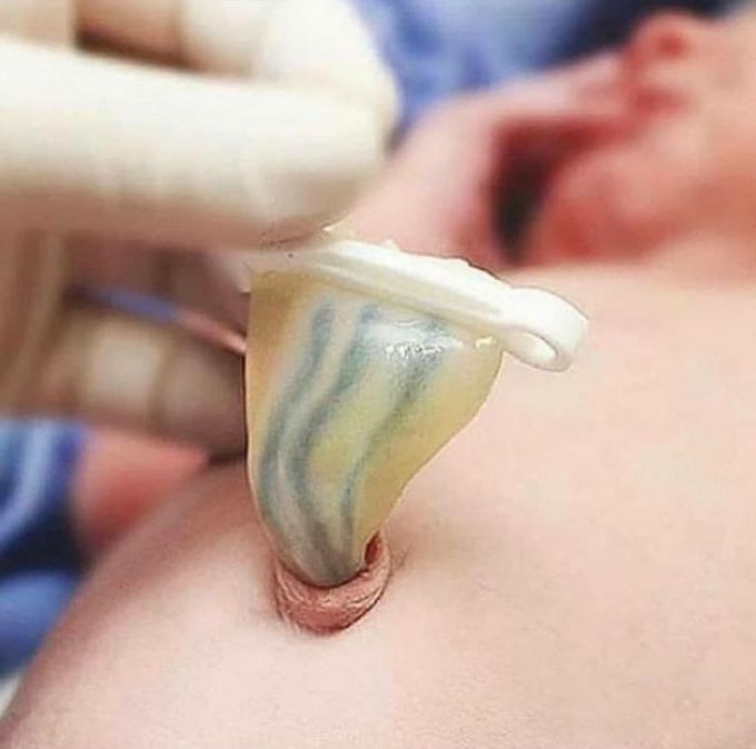 This  photo is just taken after delivery, is even more incredible because in it we can see the two arteries and a vein in the umbilical cord ,which provide oxygen and nutrition to the fetus . They lead life linking the mother with her son