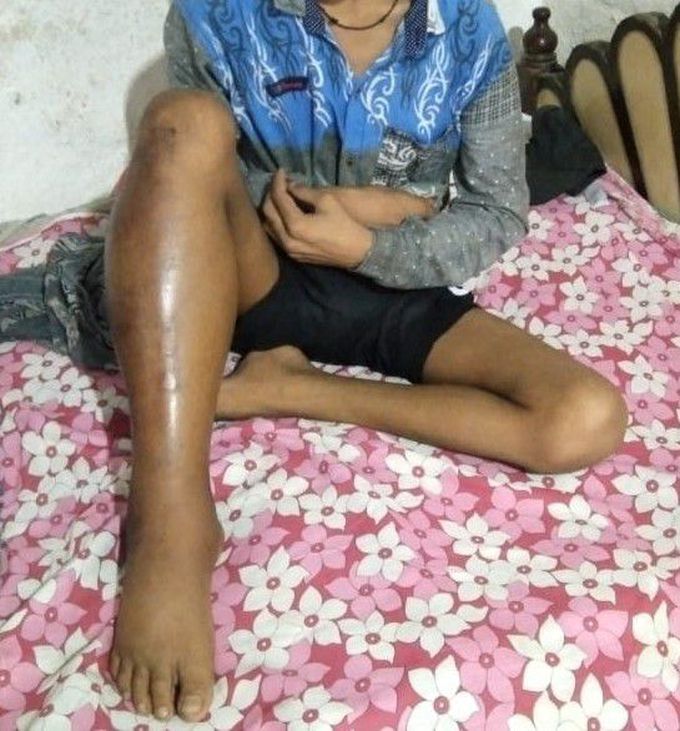 Rare disease