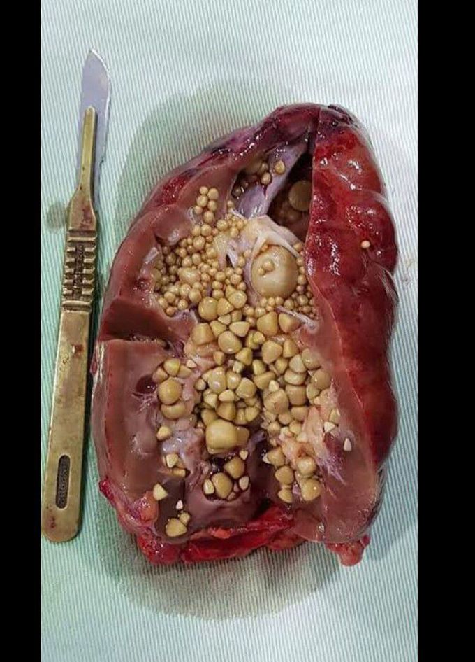Nephrolithiasis