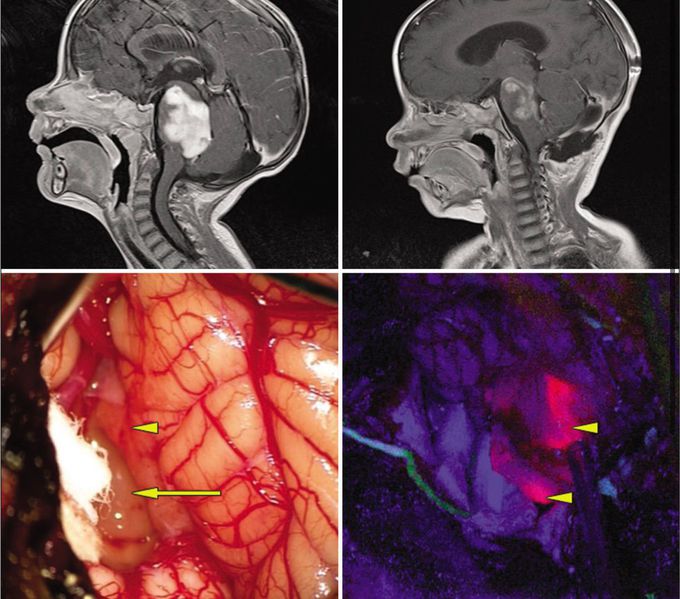 5 ALA (5 Aminolevulinic acid) for Brain Tumor Resection