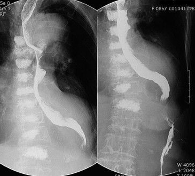 Dysphagia Aortica