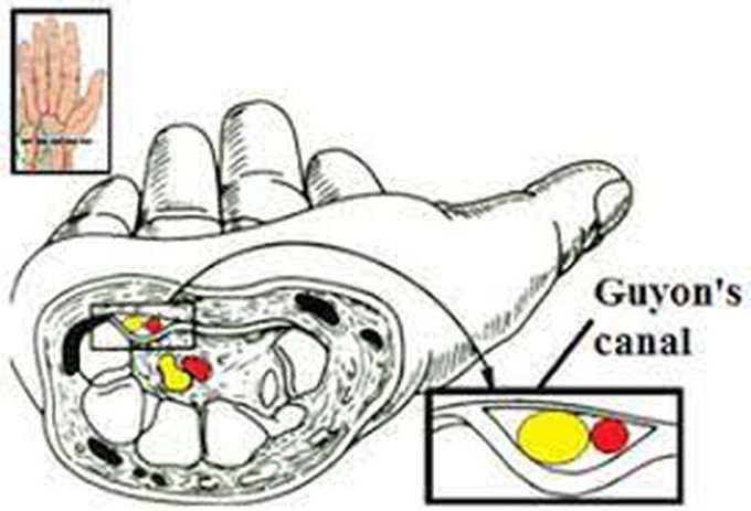 Risk Factors of Guyon’s Canal Syndrome