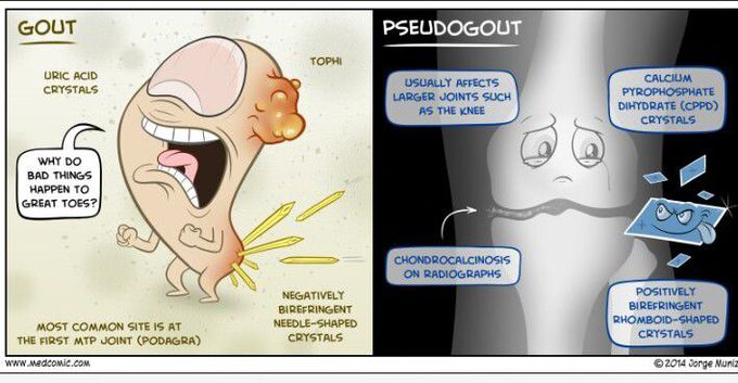 Difference between gout and pseudogout