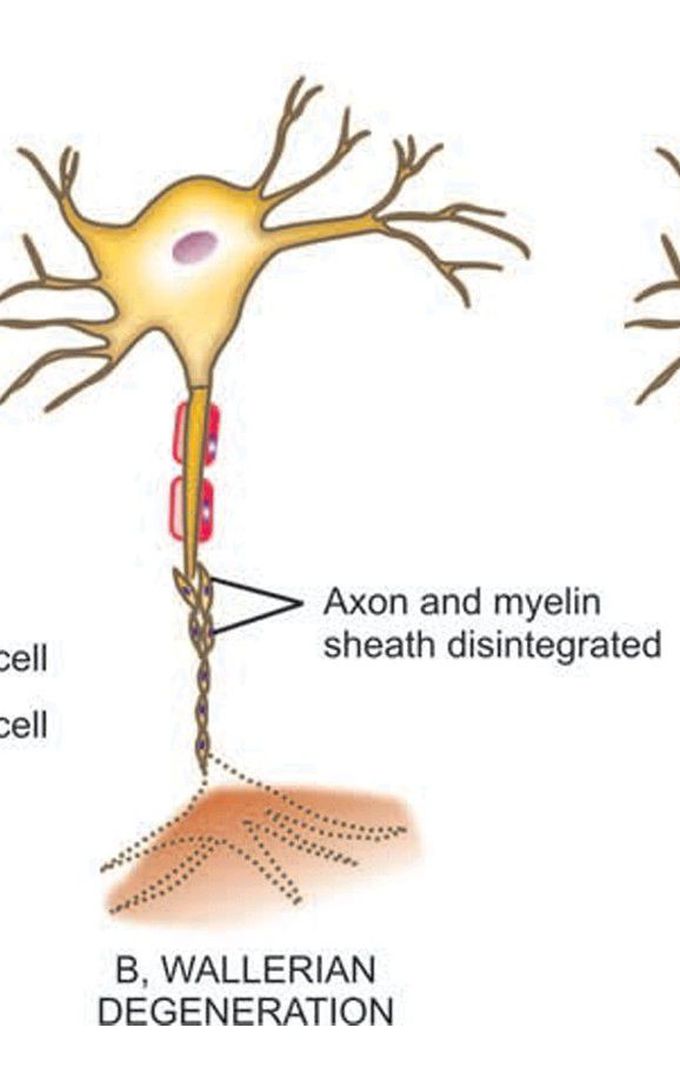 Pathologic reaction of peripheral nerve injury (1)