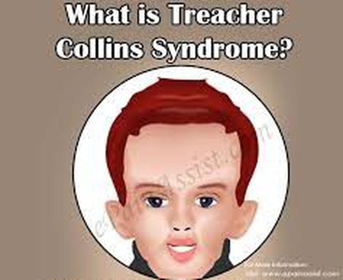 What is treacher Collins syndrome