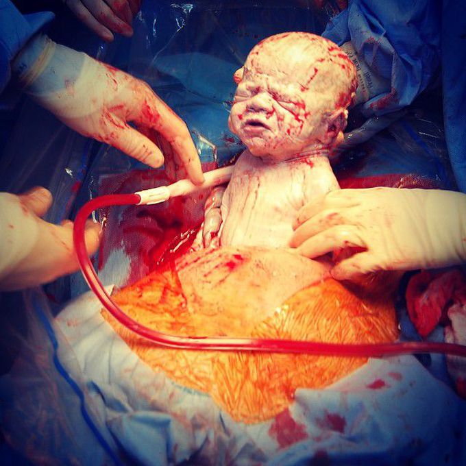 Cesarean birth (By C-section)
