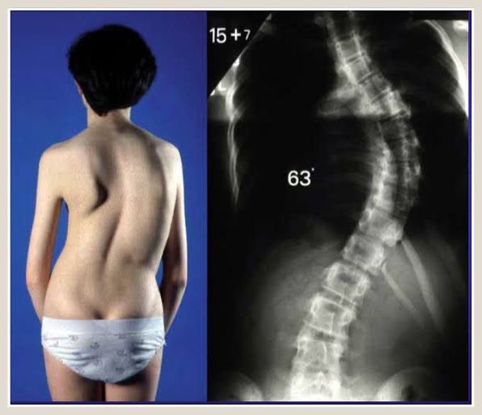 Scoliosis
