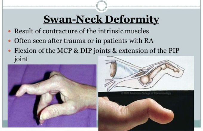 Swan Neck Deformity Of Finger Joints