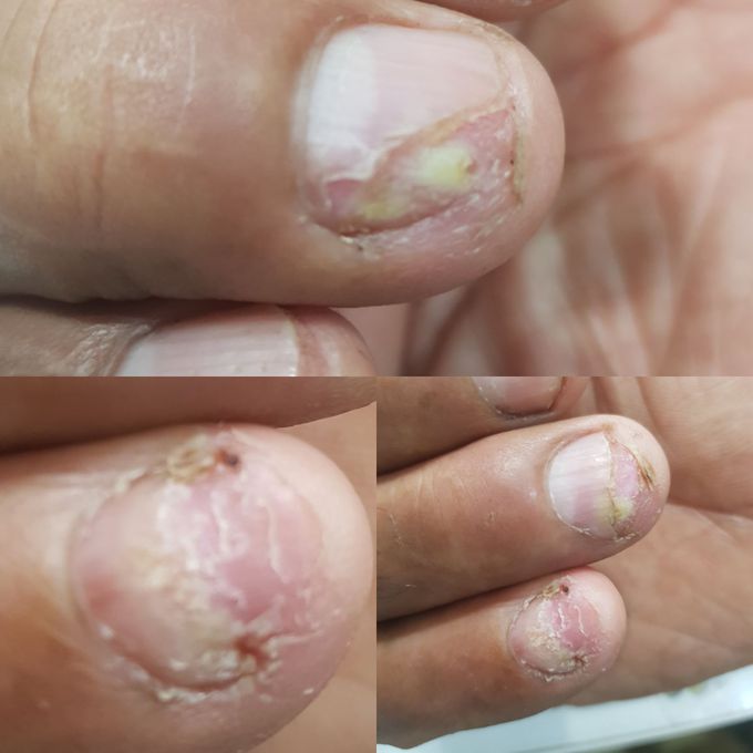 Nail disorder