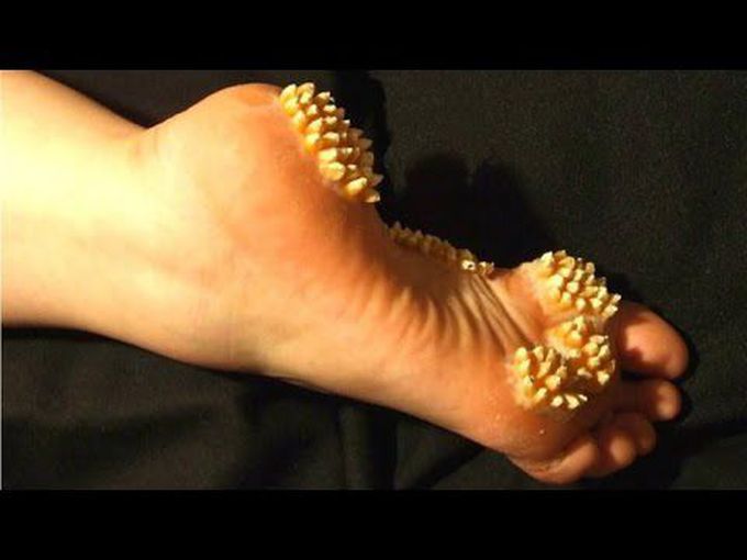 WARTS