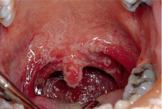 Acute pseudomembranous candidiasis