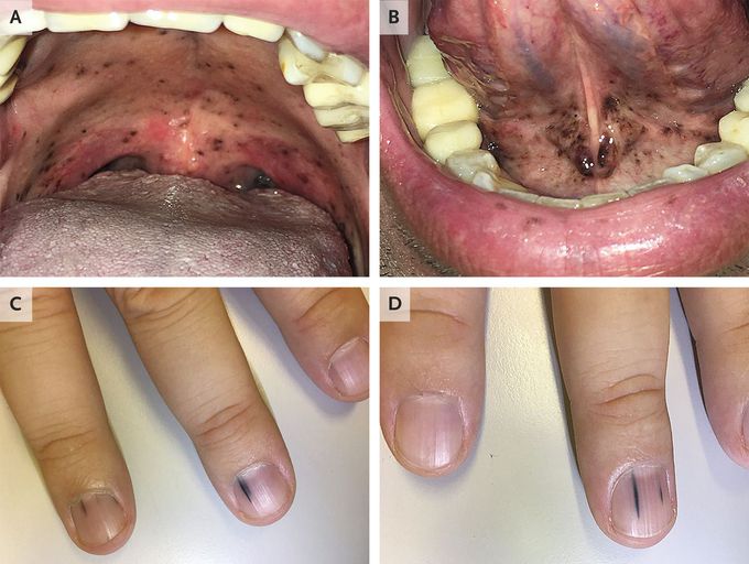 Eruptive Mucosal and Ungual Melanoma Metastases