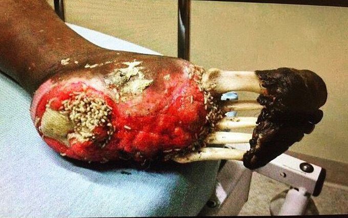 An extraordinary case of a homeless man who didn't take his shoe off for a six month period