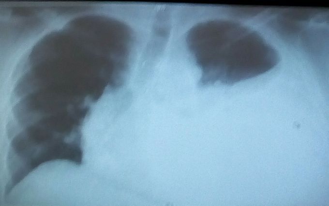 Xrays