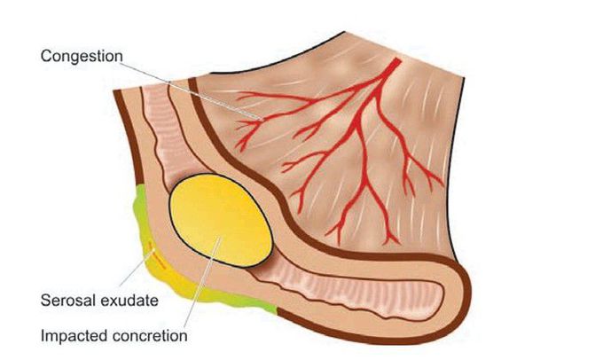 Acute appendicitis