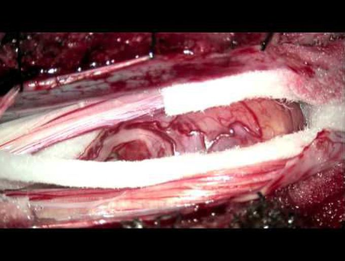 Microsurgical resection of cauda equina schwannoma with nerve root preservation