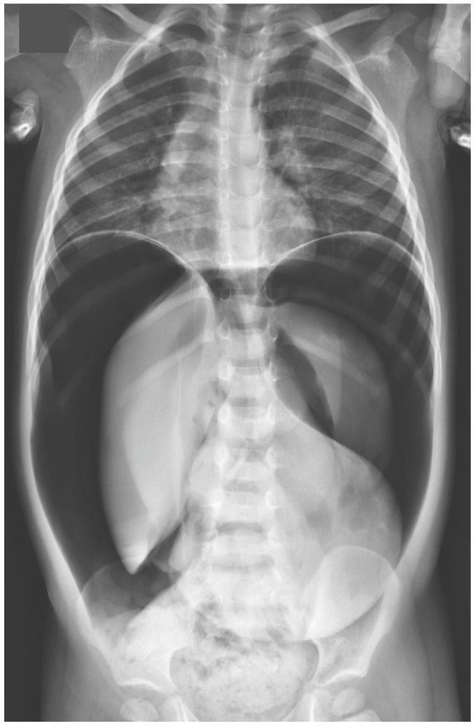 Pneumoperitoneum from a Gastric Perforation