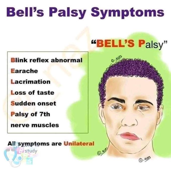 Bells Palsy