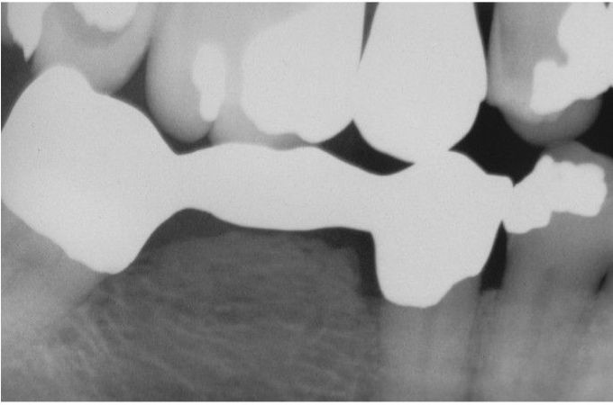 Reactive subpontine exostosis