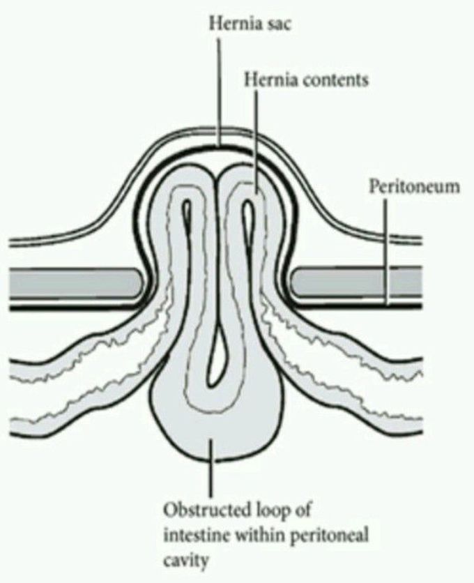 Type of Hernia in image