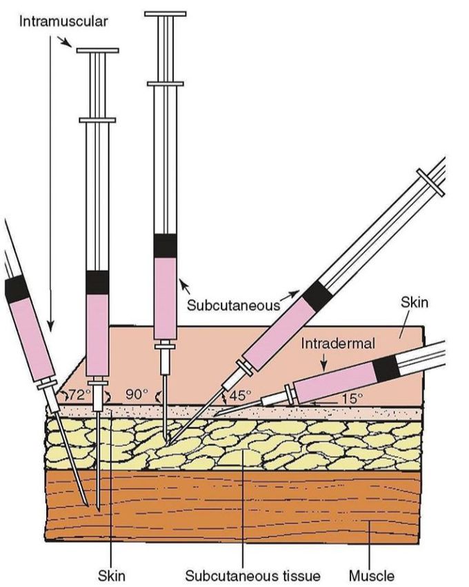 Types of injections