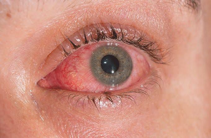 Conjunctivitis