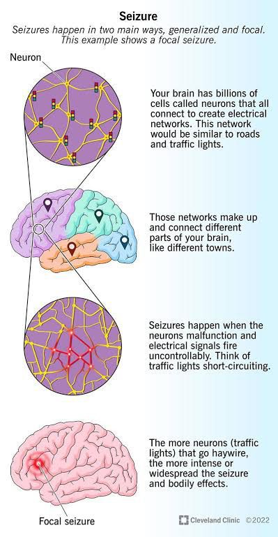 Seizures MEDizzy